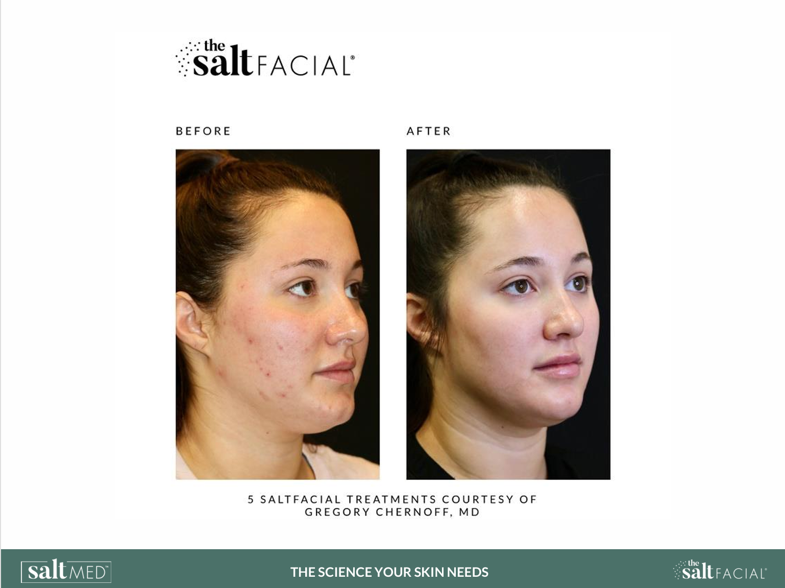 Salt Facial Before & After 1